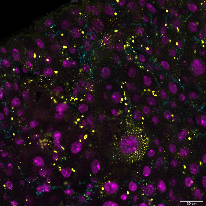 Glowing purple and yellow dots on a black background. The image shows part of a fly gut with fluorescent staining marking ubiquitin (cyan) and p62 (yellow), both of which are commonly found in disease-related protein aggregates. Cell nuclei are shown in purple. 