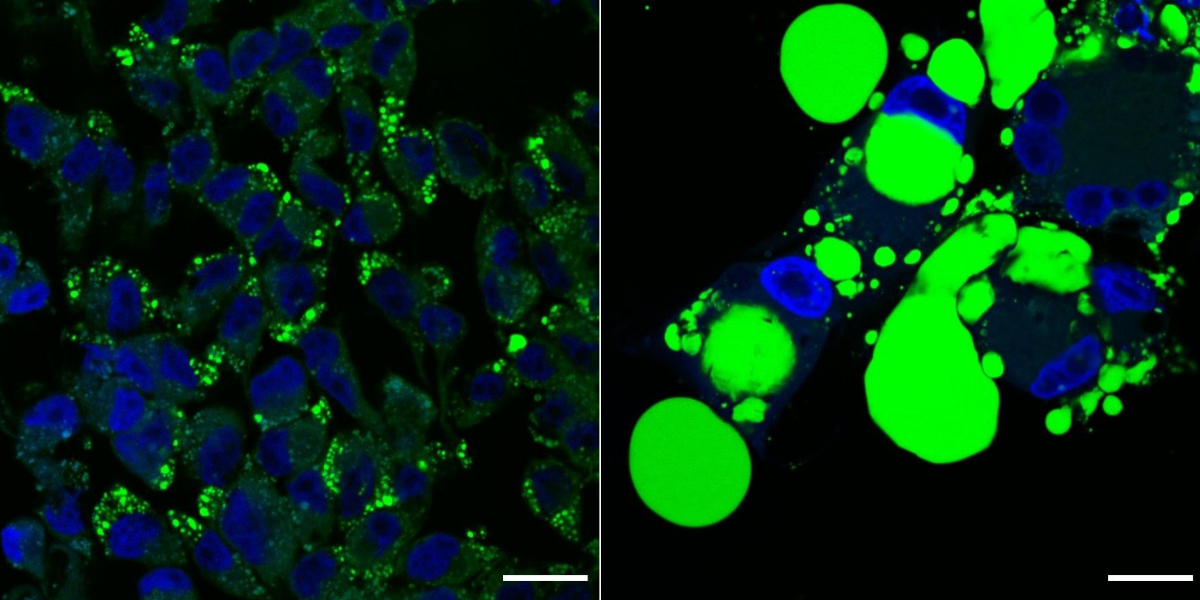 Signalling pathway research helps discover a new drug target for aggressive eye cancer