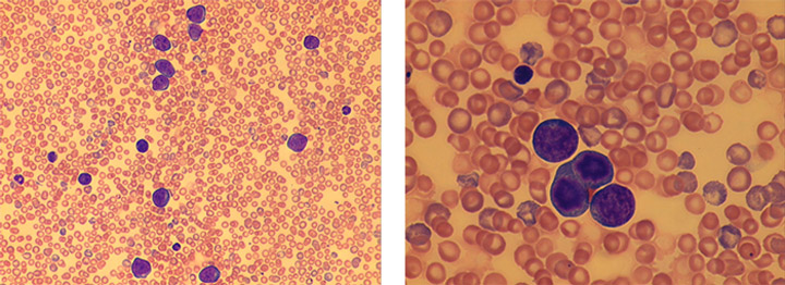 Circulating lymphoblasts 01