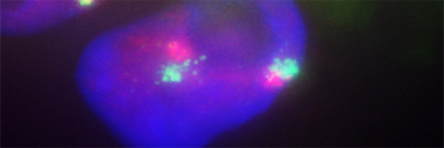 Understanding X-chromosome silencing in humans